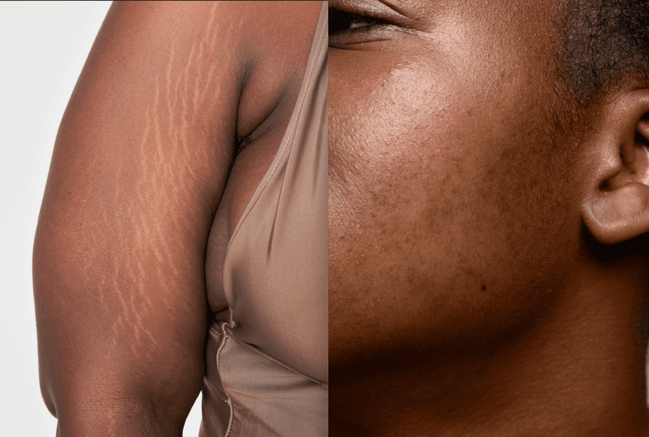 Dark spots and stretch marks
