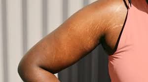 Stretchmarks